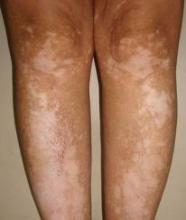 白癜风图片 白癜风图片